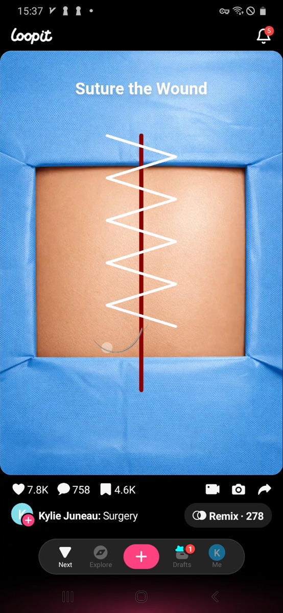 Loopit Surgery wound being sutured with a white zigzag stitch crossing the red cut.